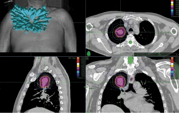 5D Clinics - SBRT Revolution in Lung Radiotherapy Dr Sean Bydder Medical Forum article